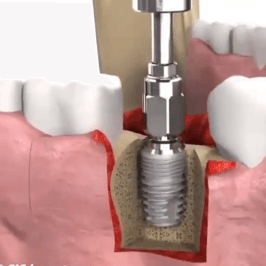 single implant